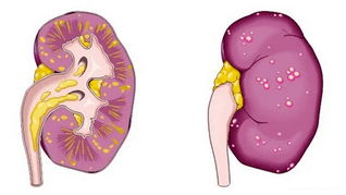 which causes acute prostatitis