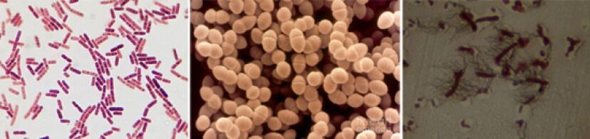 E. coli, fecal enterococci and proteus are the main causes of chronic bacterial prostatitis