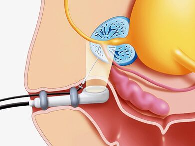 Puncture prostate biopsy